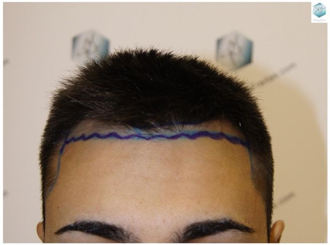 Injerto Capilar Técnica FUE 1683 Grafts 3705 Pelos 1 INJERTO CAPILAR