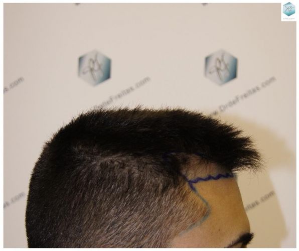 Injerto Capilar Técnica FUE 1683 Grafts 3705 Pelos 4 INJERTO CAPILAR