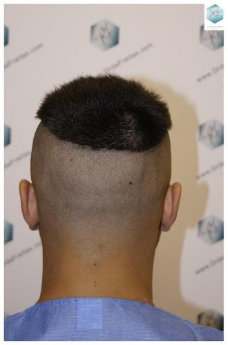 Injerto Capilar Técnica FUE 1683 Grafts 3705 Pelos 28 INJERTO CAPILAR