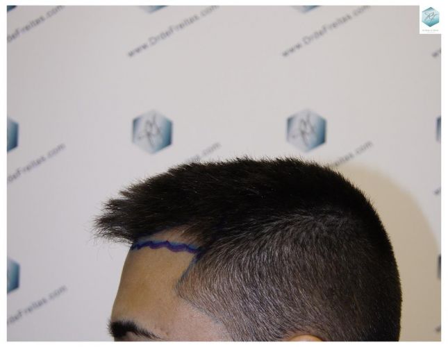 Injerto Capilar Técnica FUE 1683 Grafts 3705 Pelos 5 INJERTO CAPILAR