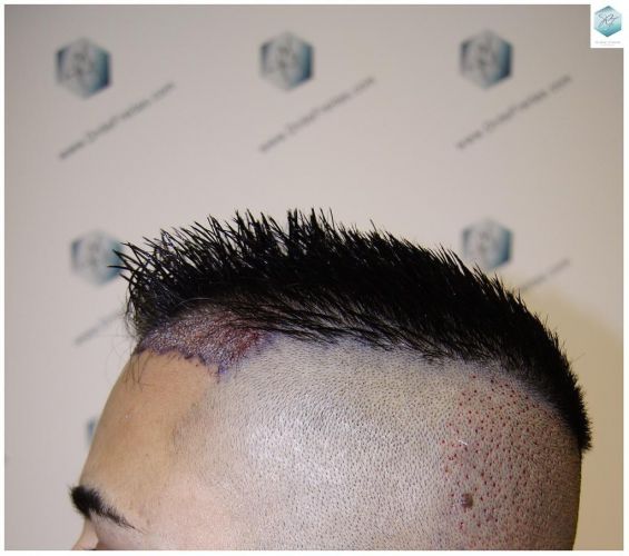Injerto Capilar Técnica FUE 1683 Grafts 3705 Pelos 7 INJERTO CAPILAR