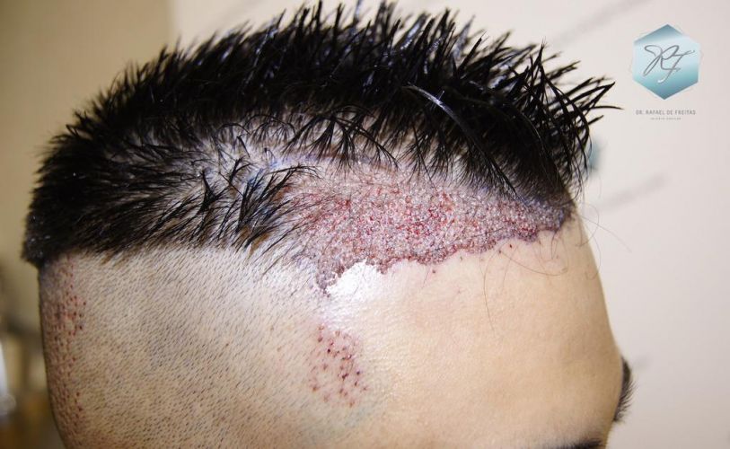 Injerto Capilar Técnica FUE 1683 Grafts 3705 Pelos 10 INJERTO CAPILAR