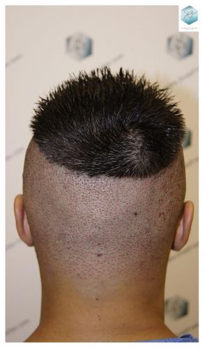 Injerto Capilar Técnica FUE 1683 Grafts 3705 Pelos 29 INJERTO CAPILAR