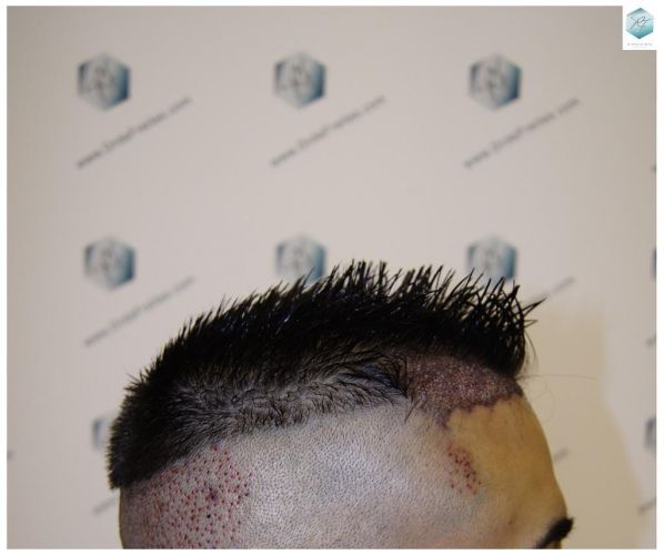 Injerto Capilar Técnica FUE 1683 Grafts 3705 Pelos 6 INJERTO CAPILAR