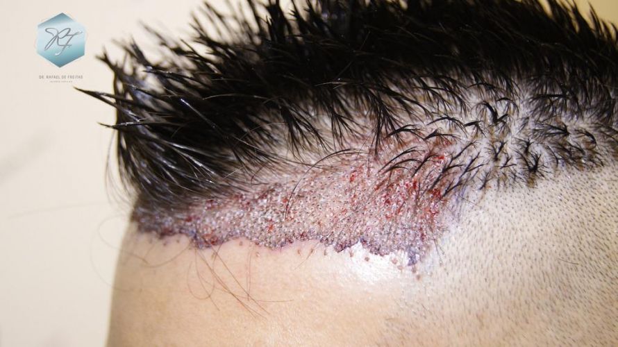 Injerto Capilar Técnica FUE 1683 Grafts 3705 Pelos 11 INJERTO CAPILAR