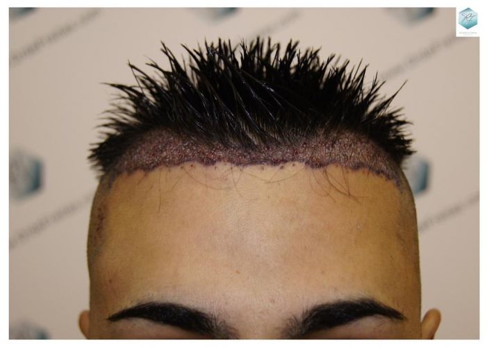 Injerto Capilar Técnica FUE 1683 Grafts 3705 Pelos 2 INJERTO CAPILAR