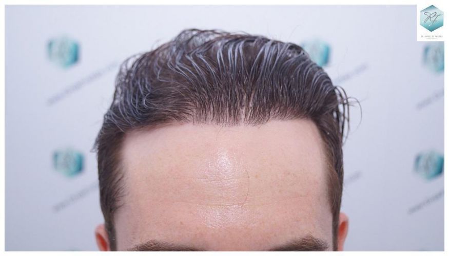 trasplante de pelo valencia