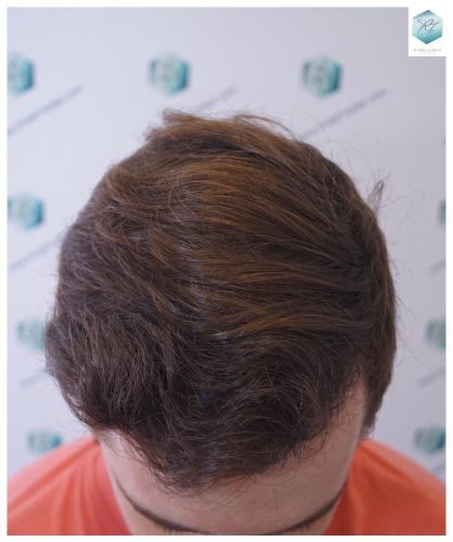 trasplante de pelo valencia