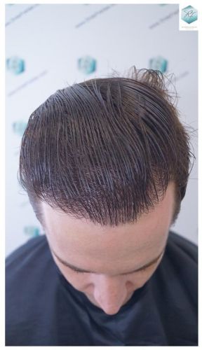 trasplante de pelo valencia