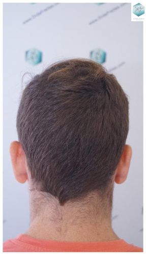 trasplante de pelo valencia