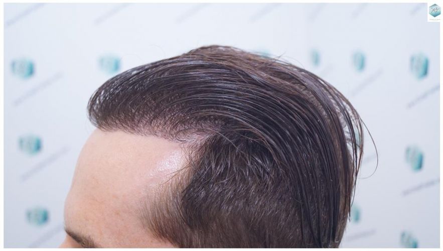 trasplante de pelo valencia