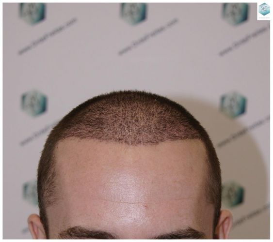 trasplante de pelo valencia