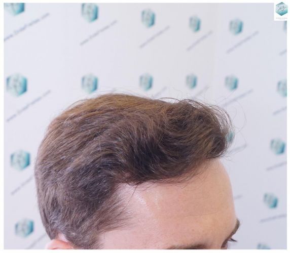 trasplante de pelo valencia