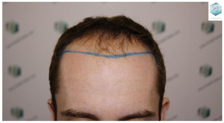trasplante de pelo valencia