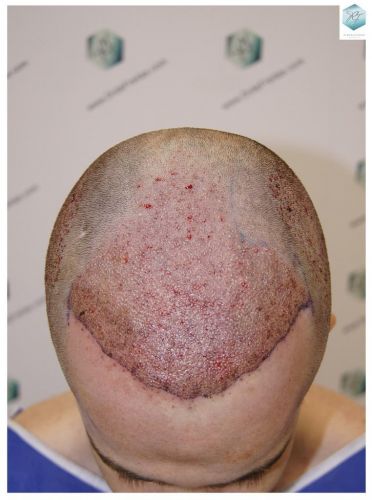 trasplante de pelo valencia