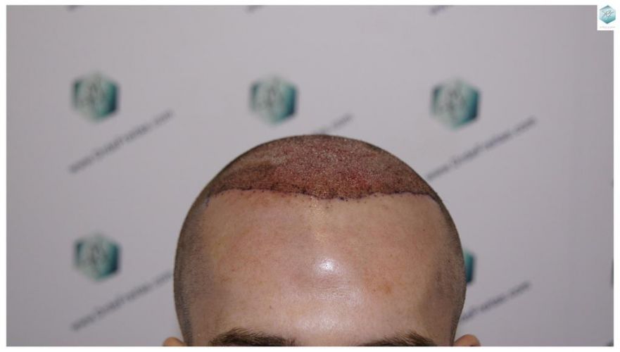trasplante de pelo valencia