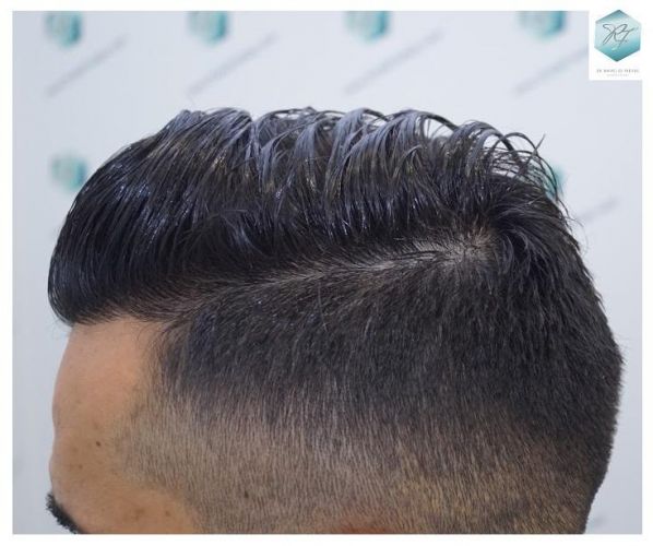 Injerto Capilar Técnica FUE 2077 Grafts (5647 Pelos) 39 MICROINJERTO CAPILAR