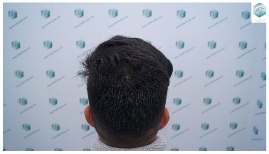 Injerto Capilar Técnica FUE 2077 Grafts (5647 Pelos) 40 MICROINJERTO CAPILAR
