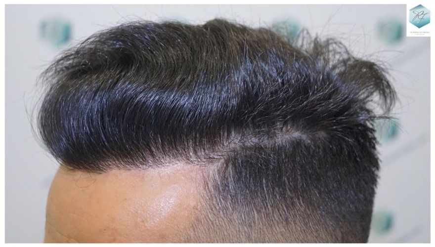 Injerto Capilar Técnica FUE 2077 Grafts (5647 Pelos) 34 MICROINJERTO CAPILAR