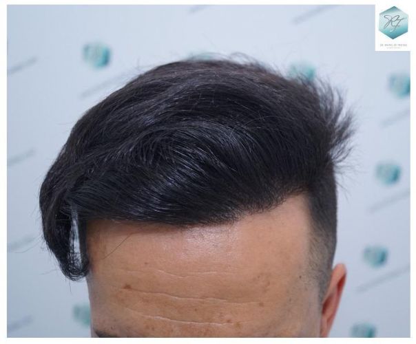 Injerto Capilar Técnica FUE 2077 Grafts (5647 Pelos) 32 MICROINJERTO CAPILAR