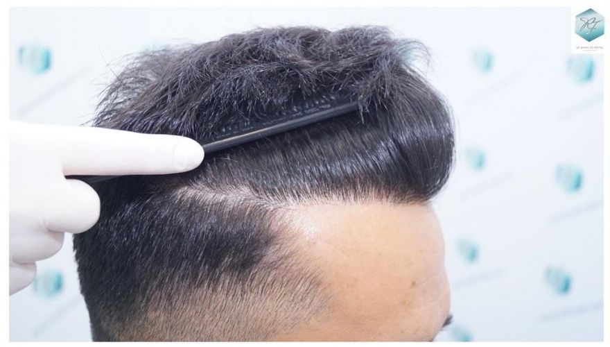 Injerto Capilar Técnica FUE 2077 Grafts (5647 Pelos) 30 MICROINJERTO CAPILAR