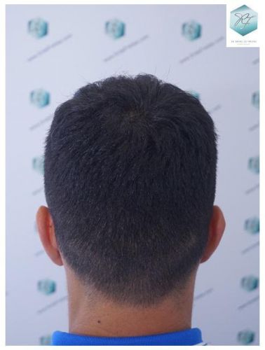 Injerto Capilar Técnica FUE 2077 Grafts (5647 Pelos) 31 MICROINJERTO CAPILAR