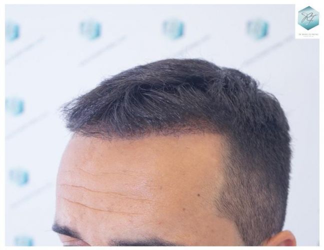 Injerto Capilar Técnica FUE 2077 Grafts (5647 Pelos) 23 MICROINJERTO CAPILAR