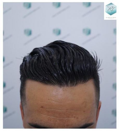 Injerto Capilar Técnica FUE 2077 Grafts (5647 Pelos) 36 MICROINJERTO CAPILAR