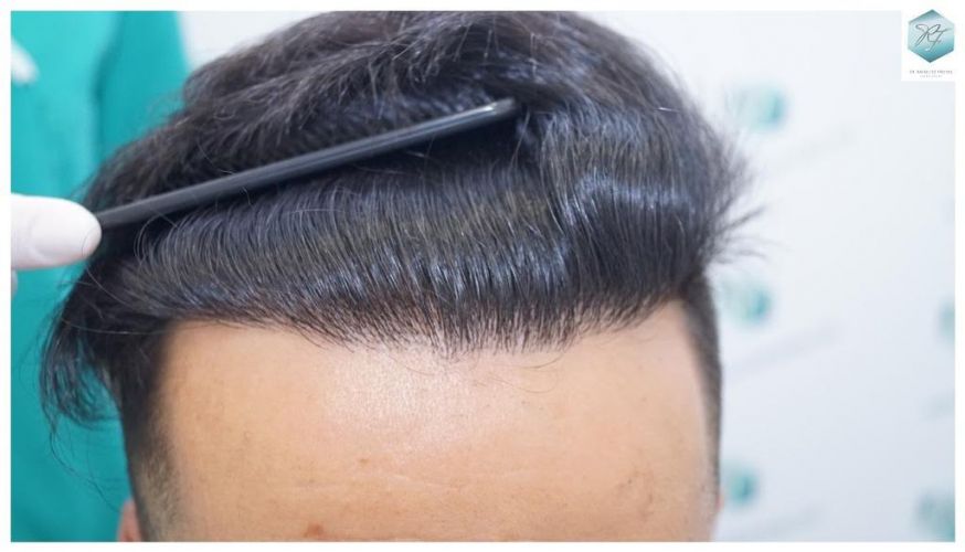 Injerto Capilar Técnica FUE 2077 Grafts (5647 Pelos) 28 MICROINJERTO CAPILAR