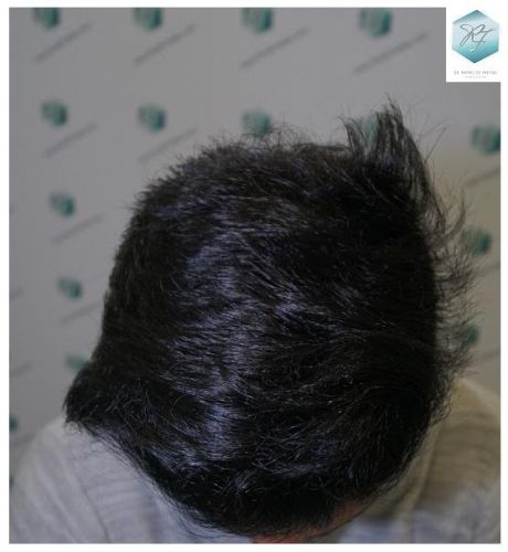 Injerto Capilar Técnica FUE 2077 Grafts (5647 Pelos) 27 MICROINJERTO CAPILAR