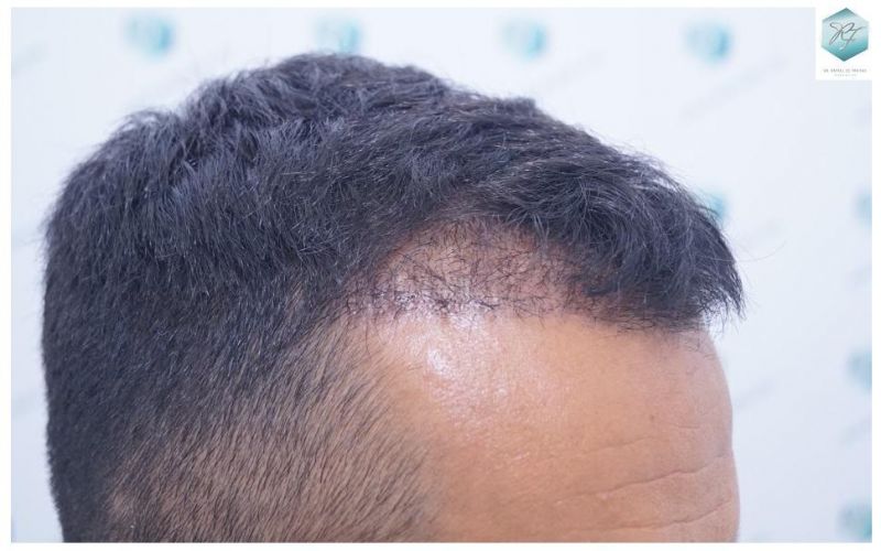 Injerto Capilar Técnica FUE 2077 Grafts (5647 Pelos) 22 MICROINJERTO CAPILAR