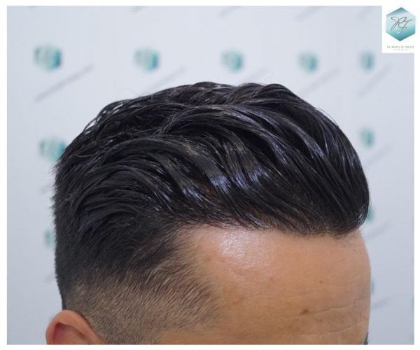 Injerto Capilar Técnica FUE 2077 Grafts (5647 Pelos) 37 MICROINJERTO CAPILAR