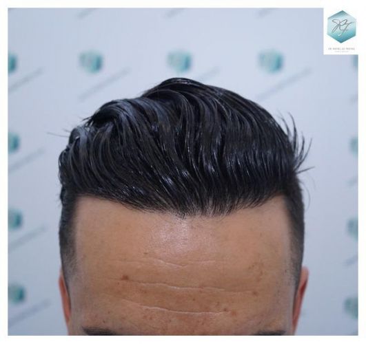 Injerto Capilar Técnica FUE 2077 Grafts (5647 Pelos) 35 MICROINJERTO CAPILAR