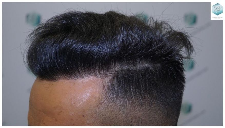 Injerto Capilar Técnica FUE 2077 Grafts (5647 Pelos) 33 MICROINJERTO CAPILAR