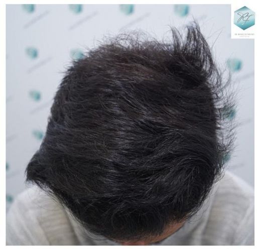 Injerto Capilar Técnica FUE 2077 Grafts (5647 Pelos) 26 MICROINJERTO CAPILAR