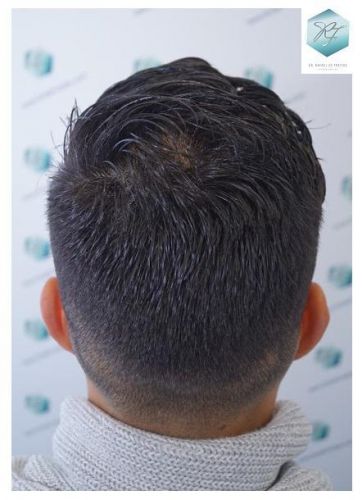 Injerto Capilar Técnica FUE 2077 Grafts (5647 Pelos) 44 MICROINJERTO CAPILAR