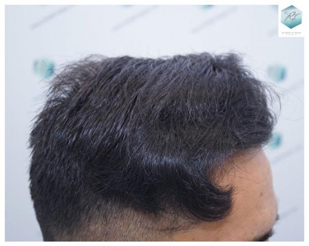 Injerto Capilar Técnica FUE 2077 Grafts (5647 Pelos) 29 MICROINJERTO CAPILAR