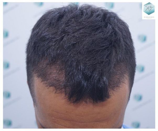 Injerto Capilar Técnica FUE 2077 Grafts (5647 Pelos) 20 MICROINJERTO CAPILAR