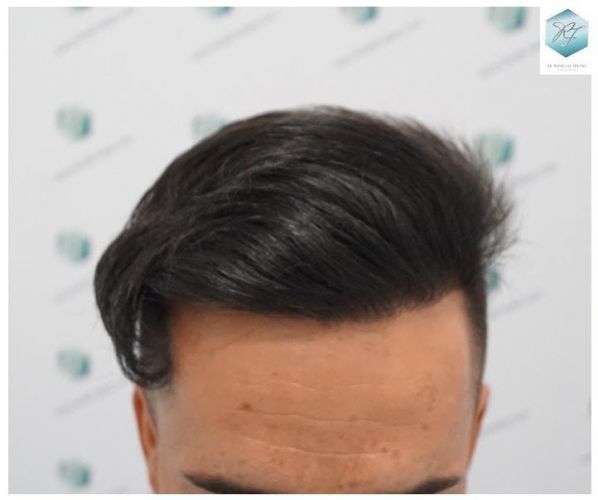 Injerto Capilar Técnica FUE 2077 Grafts (5647 Pelos) 25 MICROINJERTO CAPILAR