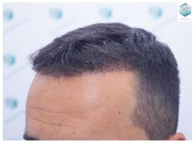 Injerto Capilar Técnica FUE 2077 Grafts (5647 Pelos) 24 MICROINJERTO CAPILAR