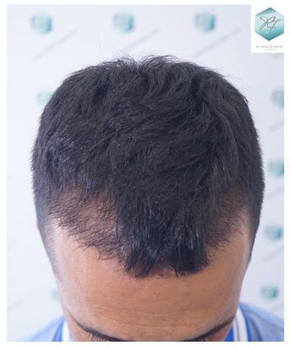Injerto Capilar Técnica FUE 2077 Grafts (5647 Pelos) 21 MICROINJERTO CAPILAR