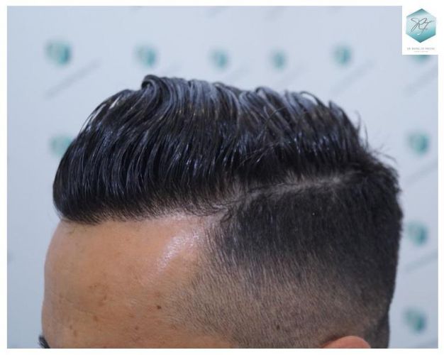 Injerto Capilar Técnica FUE 2077 Grafts (5647 Pelos) 38 MICROINJERTO CAPILAR