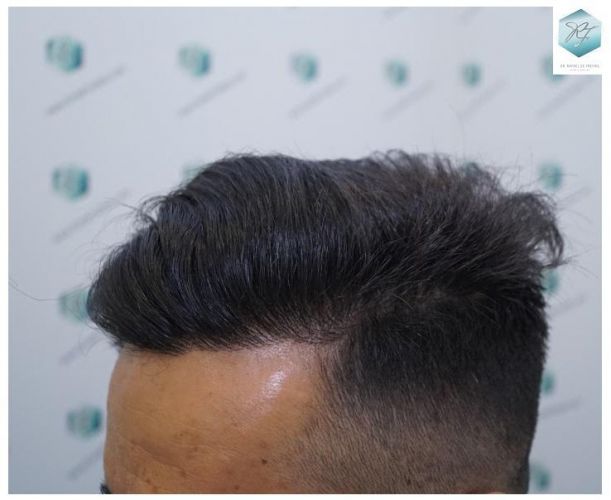 Injerto Capilar Técnica FUE 2077 Grafts (5647 Pelos) 41 MICROINJERTO CAPILAR