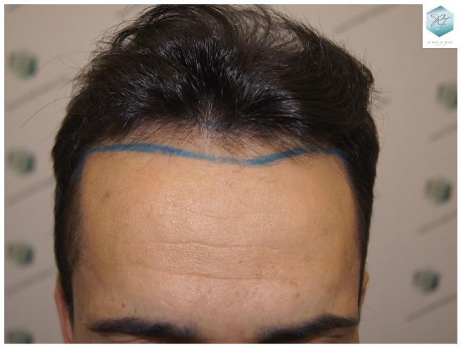 Injerto Capilar Técnica FUE 2077 Grafts (5647 Pelos) 2 trasplante de pelo valencia