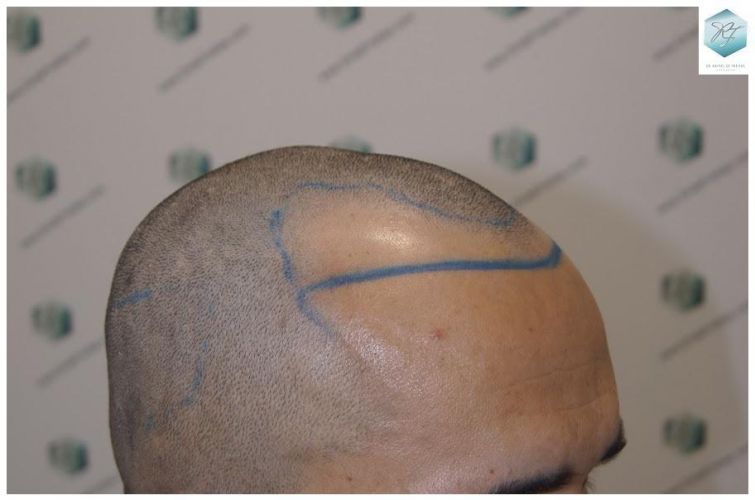Injerto Capilar Técnica FUE 2077 Grafts (5647 Pelos) 10 trasplante de pelo valencia