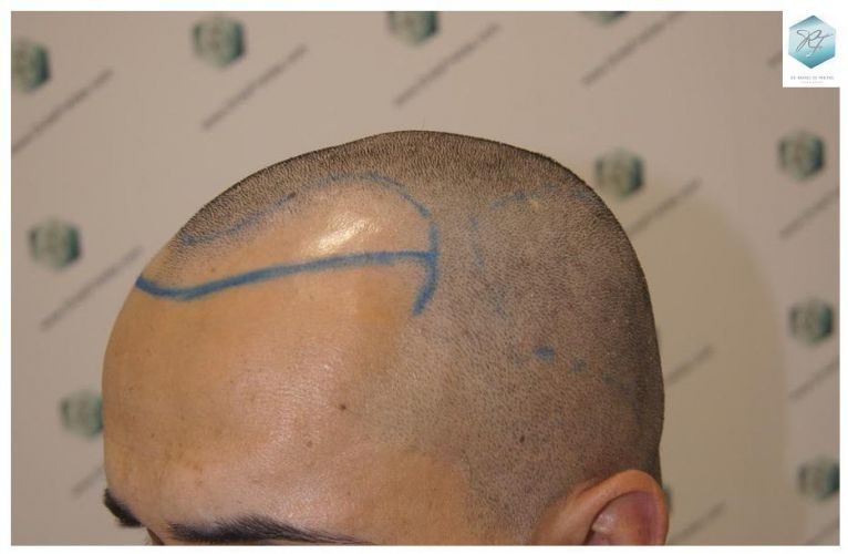 Injerto Capilar Técnica FUE 2077 Grafts (5647 Pelos) 11 trasplante de pelo valencia