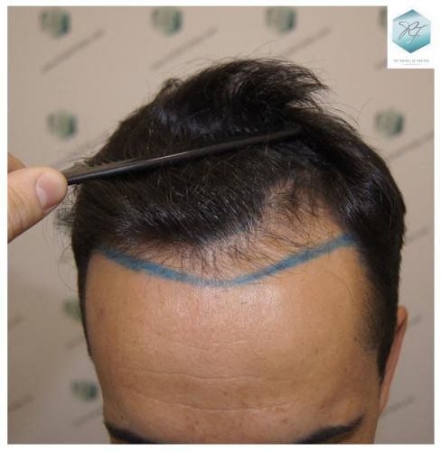 Injerto Capilar Técnica FUE 2077 Grafts (5647 Pelos) 5 trasplante de pelo valencia