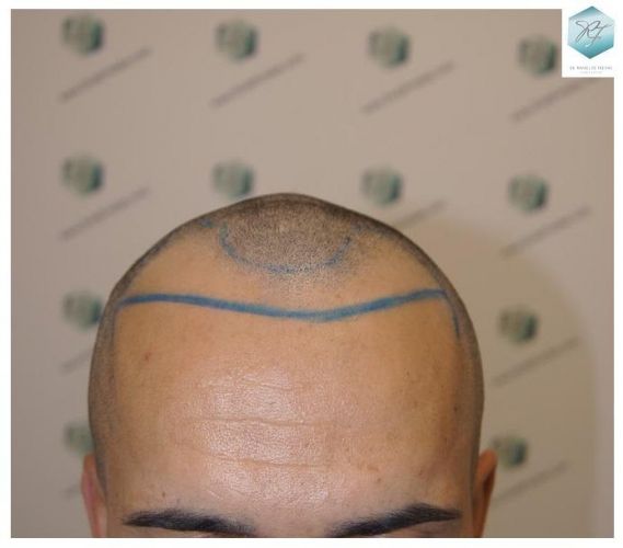 Injerto Capilar Técnica FUE 2077 Grafts (5647 Pelos) 8 trasplante de pelo valencia