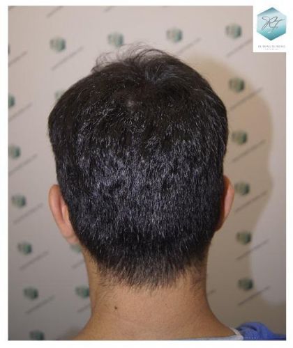 Injerto Capilar Técnica FUE 2077 Grafts (5647 Pelos) 42 trasplante de pelo valencia