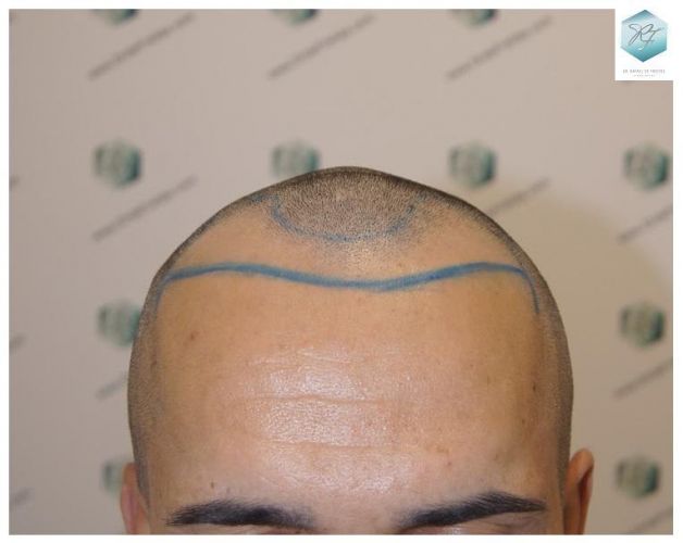 Injerto Capilar Técnica FUE 2077 Grafts (5647 Pelos) 7 trasplante de pelo valencia